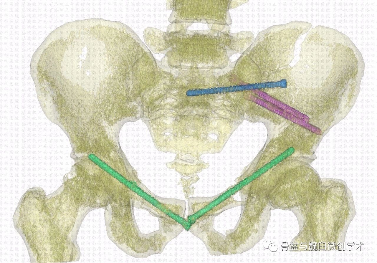经髂骨&骶骨的骶髂关节骨折脱位的微创治疗:骶髂螺钉