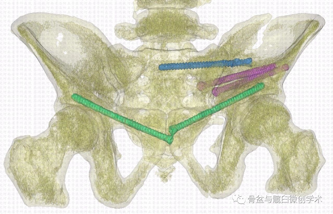 经髂骨&骶骨的骶髂关节骨折脱位的微创治疗:骶髂螺钉