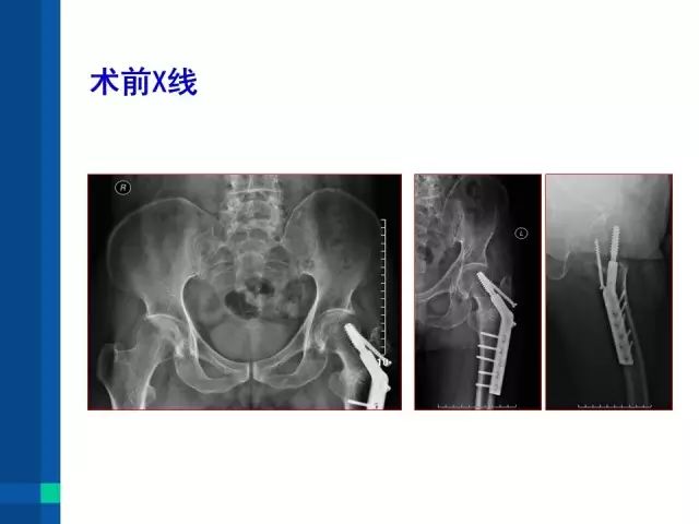 即时病例股骨转子间骨折dhs术后髋螺钉穿出失效的翻修手术治疗