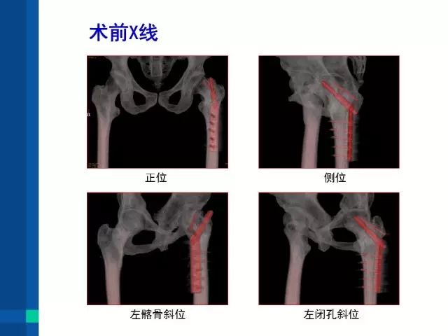 即时病例股骨转子间骨折dhs术后髋螺钉穿出失效的翻修手术治疗