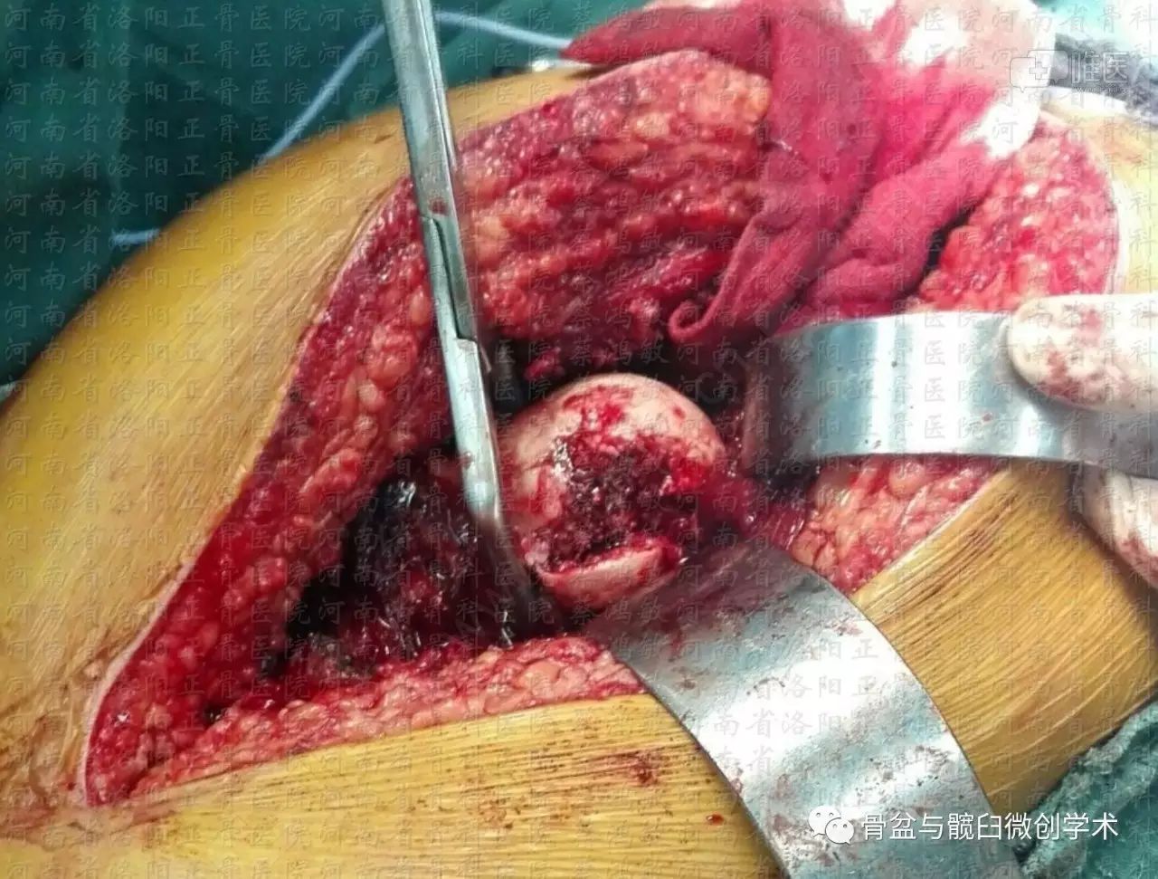 髋臼骨折 股骨头骨折的治疗——kl入路 外科脱位技术