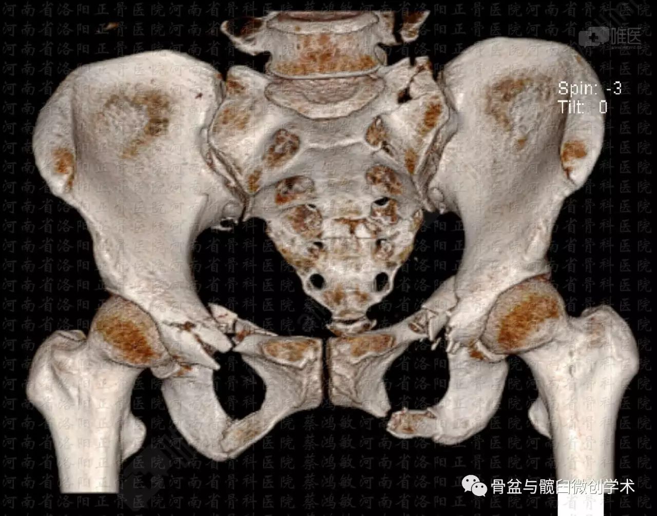 骶髂螺钉stoppa钢板治疗骨盆骨折mimics术前计划