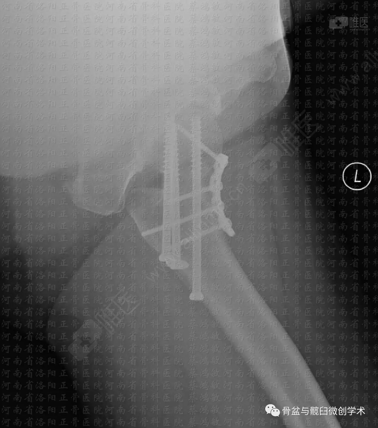 青壮年股骨颈头下型骨折的治疗空心钉股骨矩buttress钢板