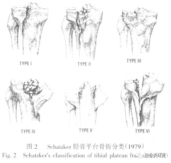 i型:外侧平台单纯楔形或纵向劈裂骨折; Ⅱ型:外侧平台劈裂—压缩骨折