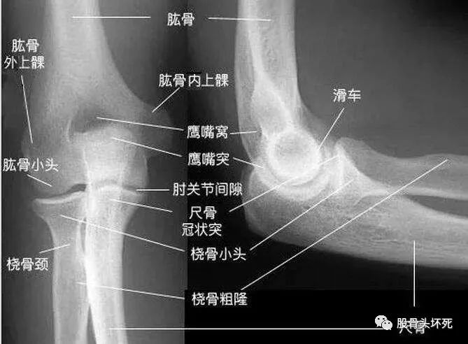 肘关节脱位