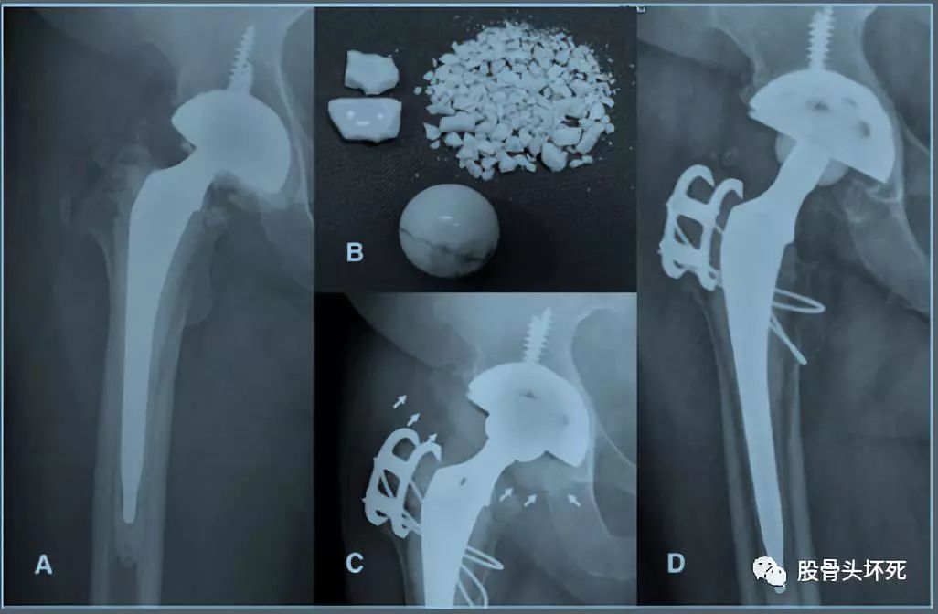 陶对陶全髋关节置换术中的可怕并发症陶瓷碎裂