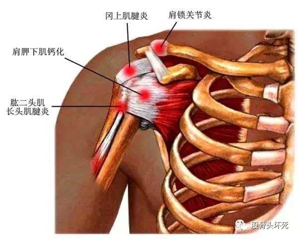 肩部疼痛,不是只有"肩周炎"