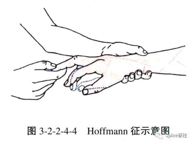 hoffman征霍夫曼征的那些事