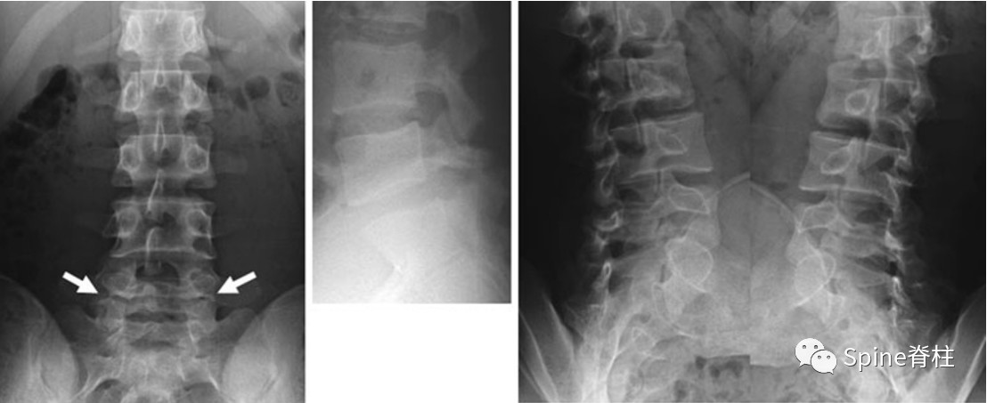 09分)上的病例报道,很好的阐述了峡部裂和椎弓根裂的变化.
