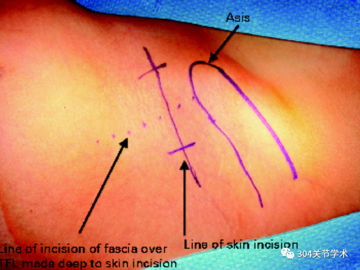手术切口示意图:实线为皮肤切口,虚线为阔筋膜张肌筋膜切口,asis为髂