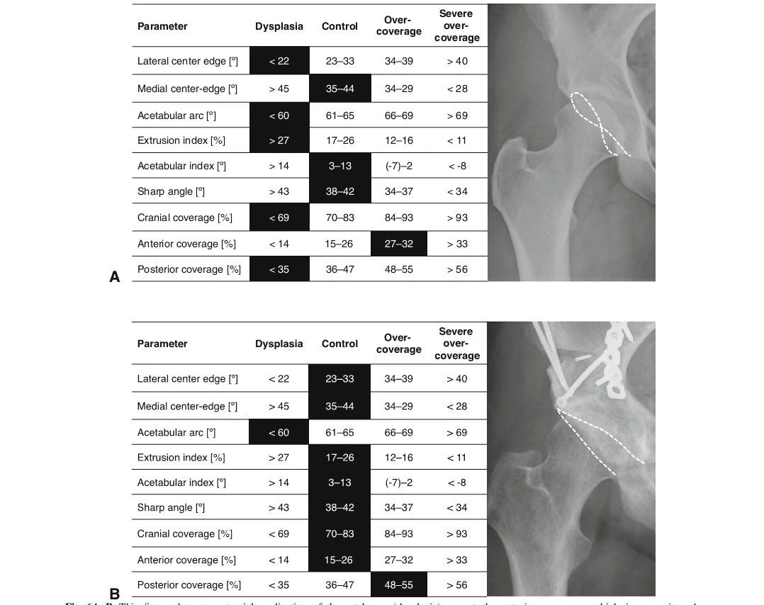 髋臼覆盖不良及过度覆盖的放射学参考值研究