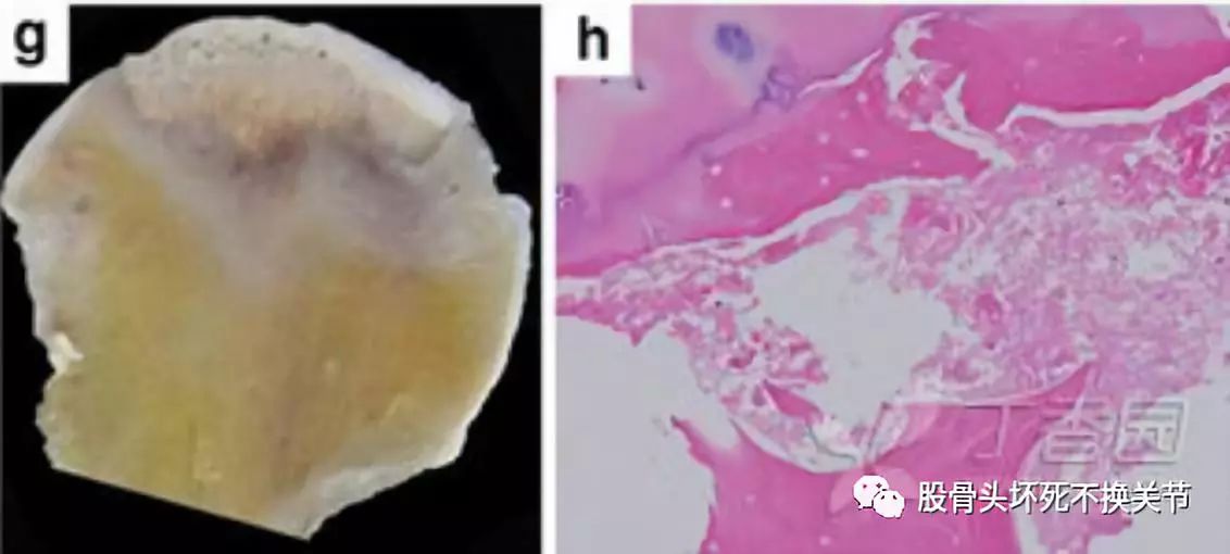 切除的股骨头冠状位切片显示存在相对明显的软骨坏死带,肉芽修复带和