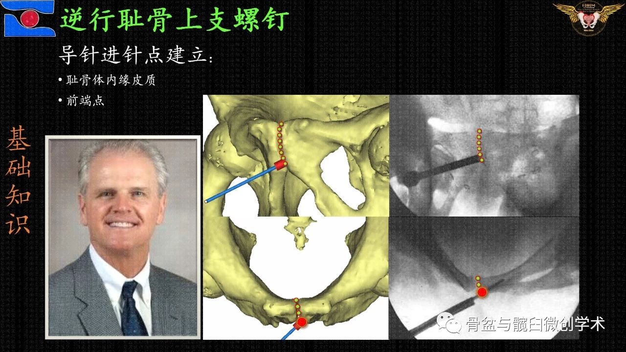 简便,精准,安全——全面解析改良的经皮逆行耻骨上支或髋臼前柱螺钉