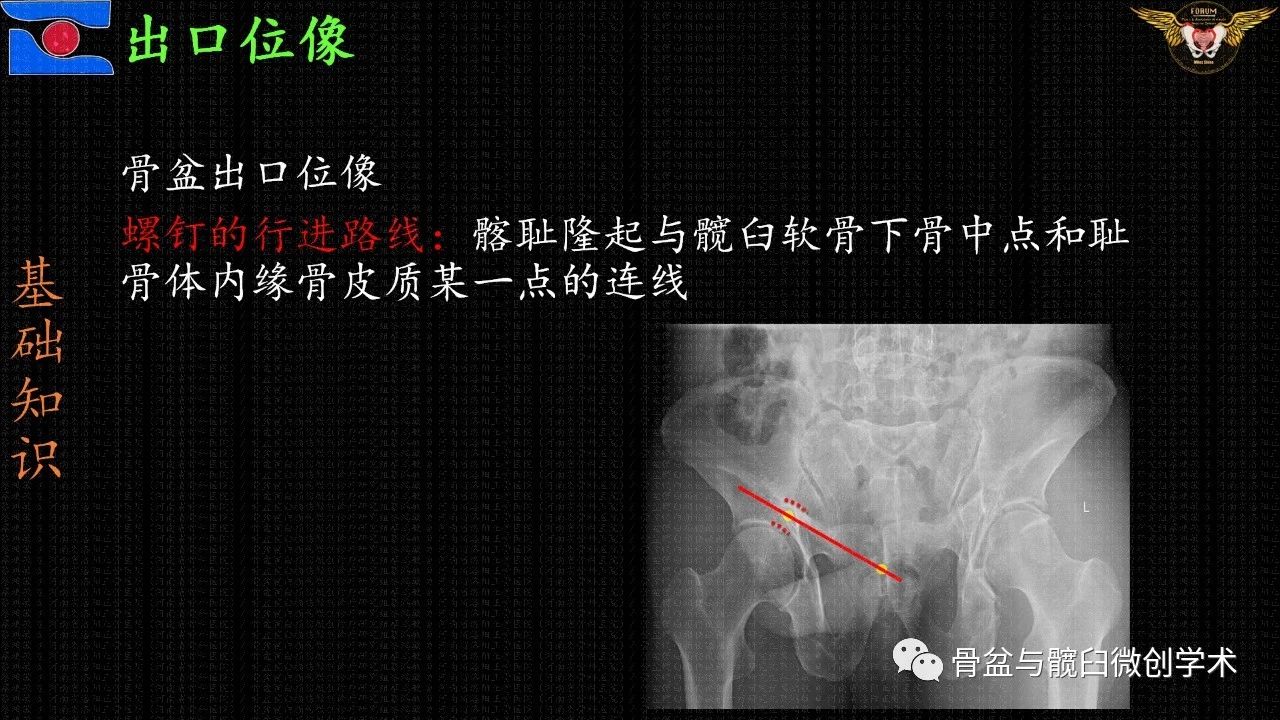 骨盆出口位像就是对原始技术的闭孔斜位出口位像的斗胆的"侧目".
