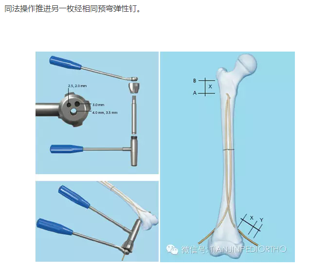 小儿骨科手术技术之一:弹性髓内钉 尾帽技术固定治疗长度不稳定型儿童