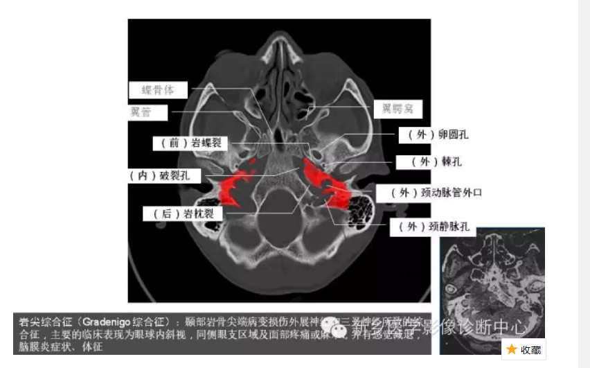 颅底孔道解剖详解