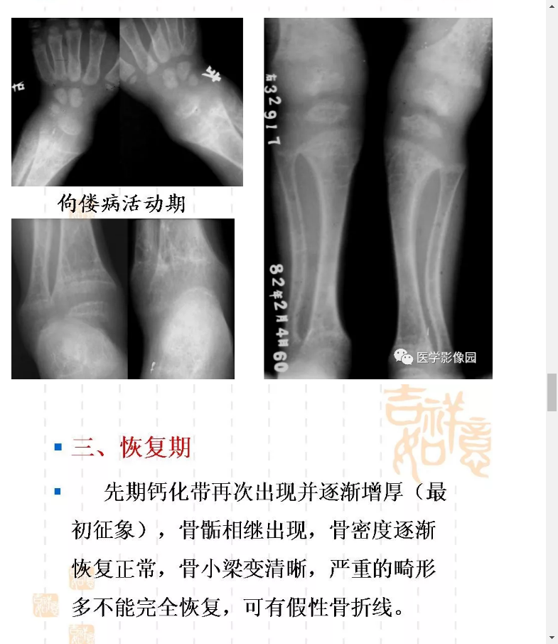 佝偻病的影像学特点有哪些?