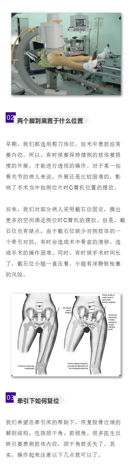 菁讲:股骨粗隆间骨折——术前如何有效摆放牵引体位?