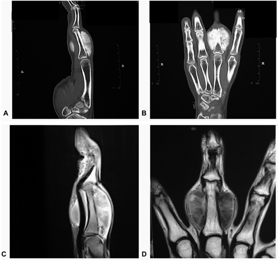 手指近节骨旁骨肉瘤病例一案 (parosteal osteosarcoma of the