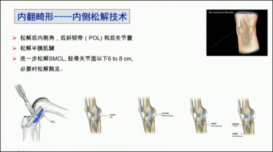 半膜肌腱进行松解,或者对浅层内侧副韧带松解,松解至胫骨关节面以下6