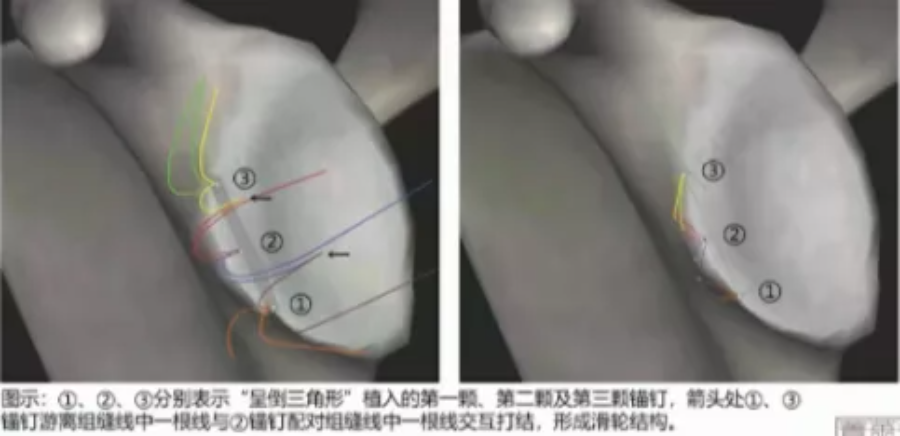 缝合技术示意图