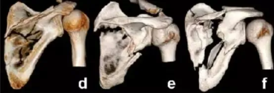 刘兆杰:肩胛骨的解剖特点及肩胛骨骨折分型
