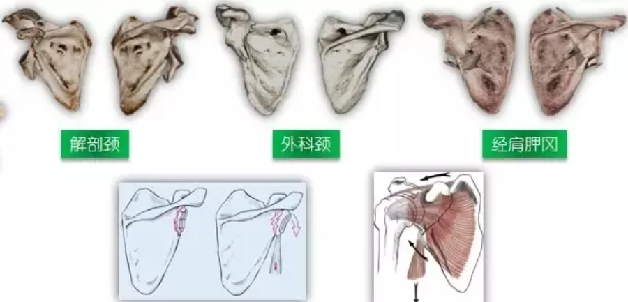 刘兆杰肩胛骨的解剖特点及肩胛骨骨折分型