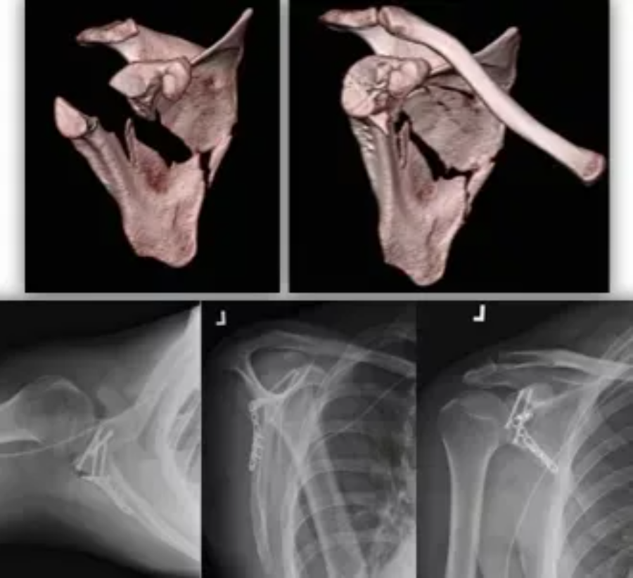 刘兆杰:肩胛骨的解剖特点及肩胛骨骨折分型