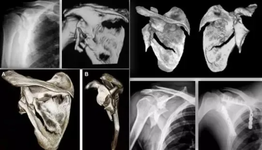 刘兆杰肩胛骨的解剖特点及肩胛骨骨折分型
