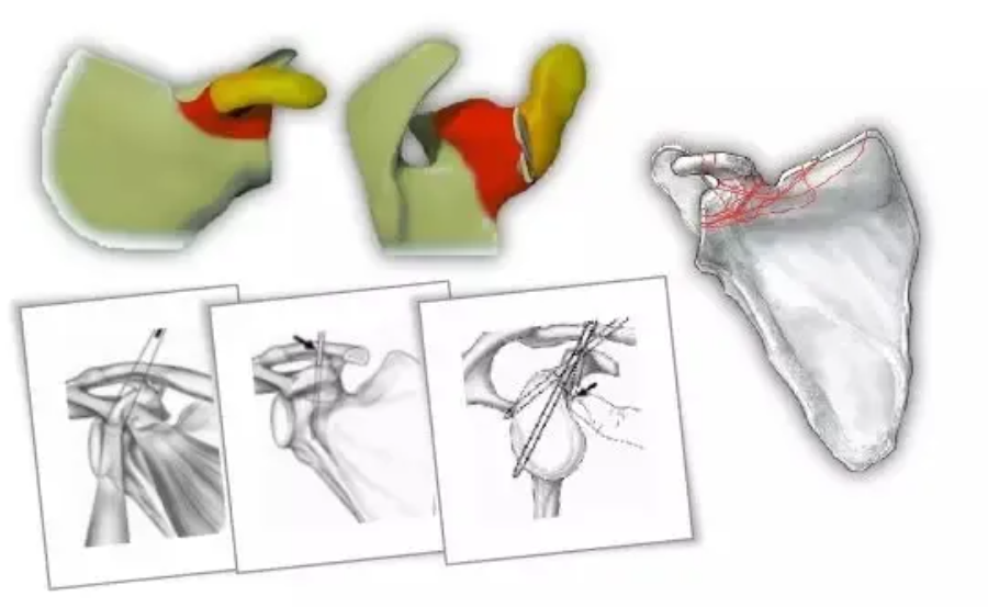 刘兆杰肩胛骨的解剖特点及肩胛骨骨折分型