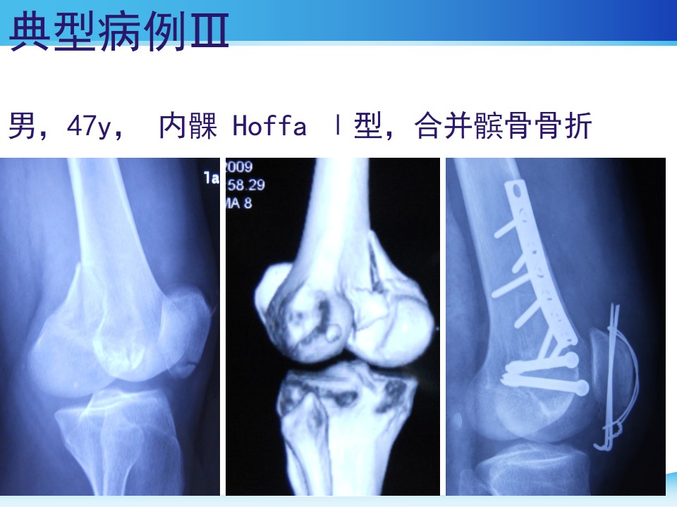 hoffai,Ⅲ型骨折属于关节内不稳定性骨折,常因由高能量损伤导致,文献