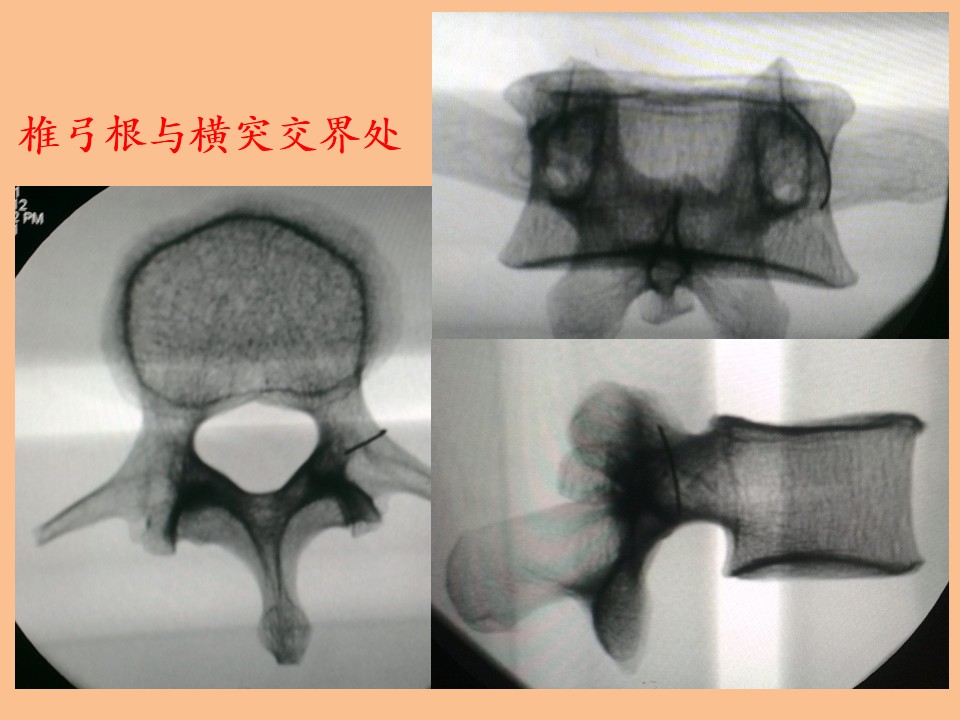 单侧穿刺椎体成形术的解剖学与影像学研究