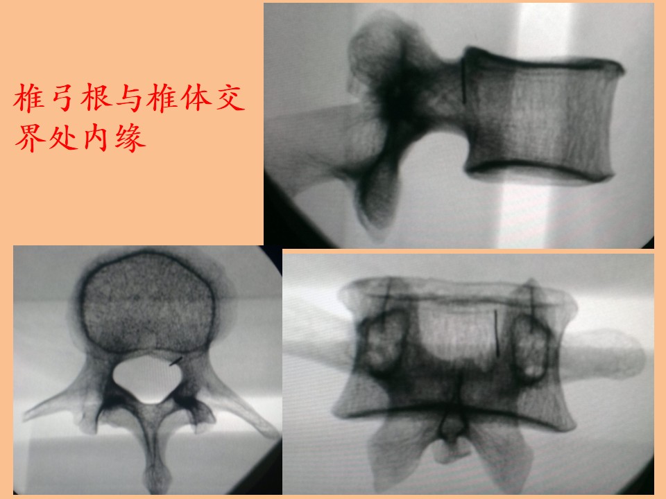 单侧穿刺椎体成形术的解剖学与影像学研究