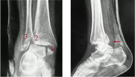 三踝骨折的损伤机制及特殊性分析骨医小灶第二十四期上
