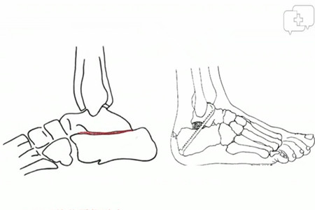 唯医专题丨足踝系列ii-跟骨骨折专题