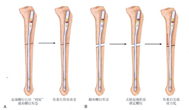 胫骨远端骨干骨折手术治疗选择:髓内钉 vs 钢板