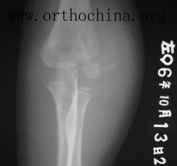 挠骨小头骨折,腓骨小头,股骨骨折(第2页)_大山谷图库