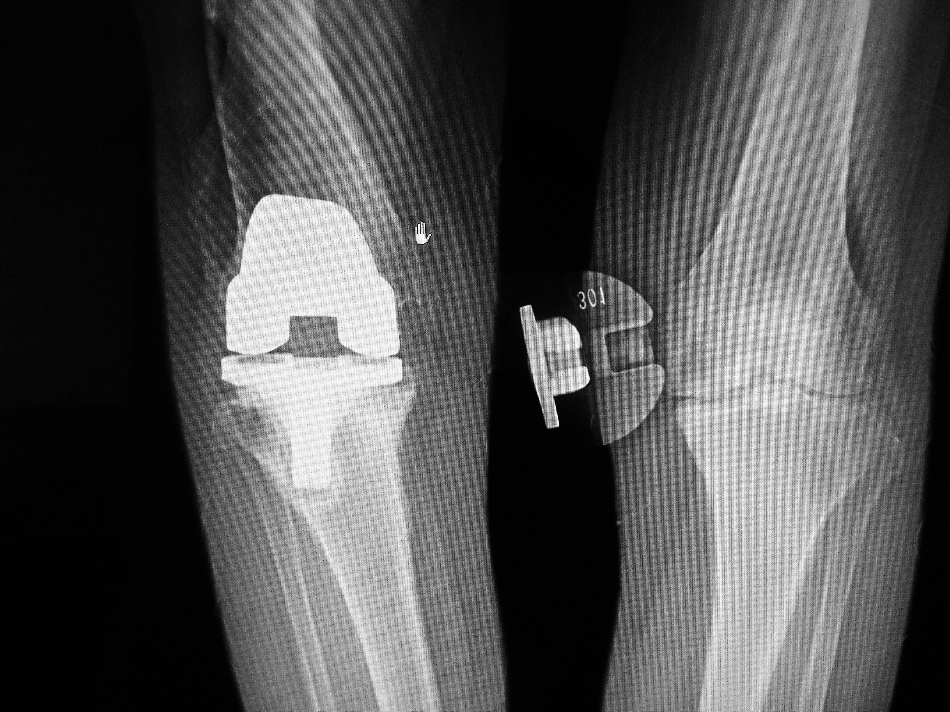 关节外畸形人工膝关节置换后翻修术