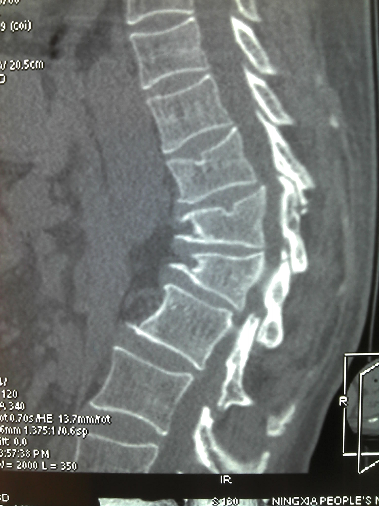 胸十二压缩性骨折图片