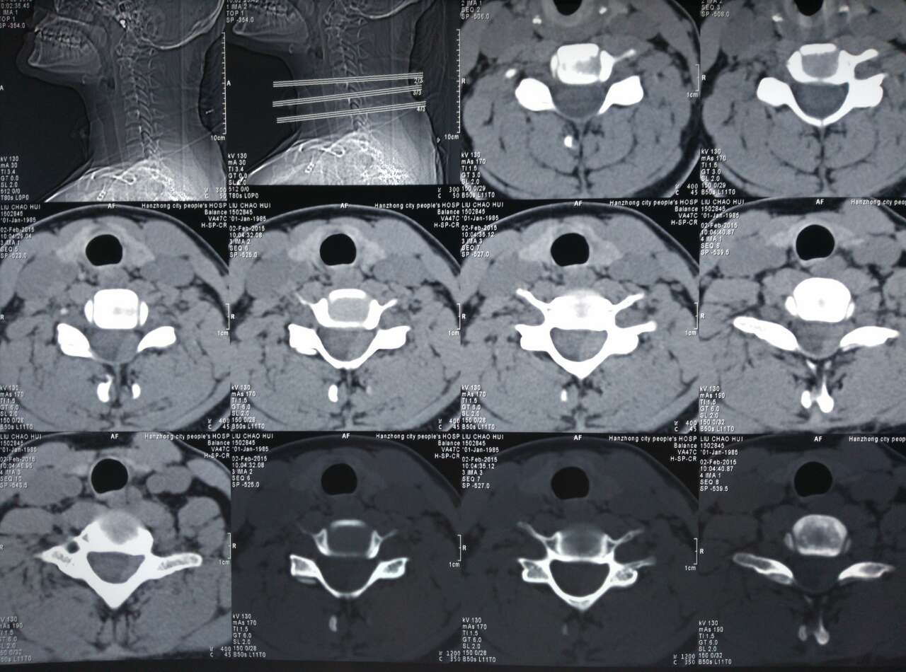頸椎ct