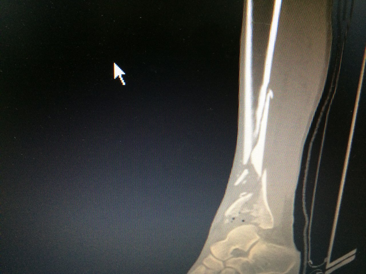 60岁男性双胫骨骨折,唯医,allinmd