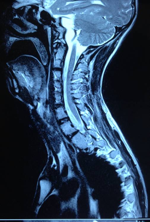 斐19岁男性发现颈胸背部畸形3年,疑马凡式综合症