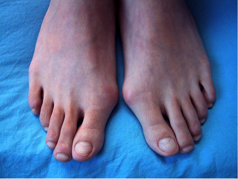 微创截骨术治疗足踇外翻畸形 - 好大夫在线