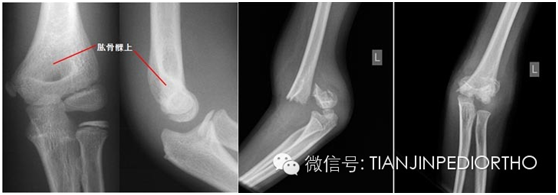 兒童肱骨髁上骨折:父母需要知道的事情