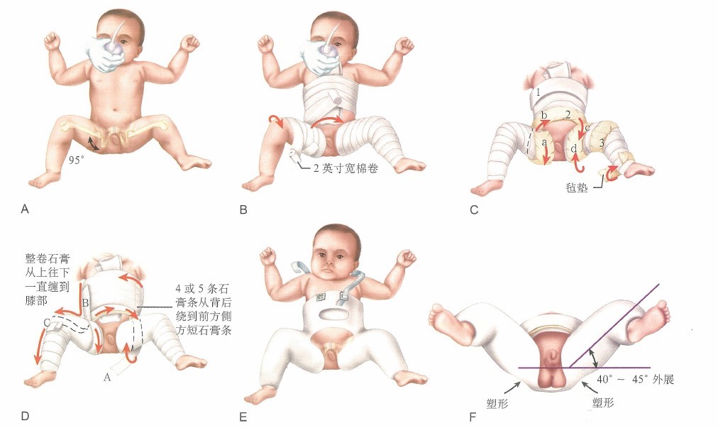 婴儿髋关节正常打开图图片