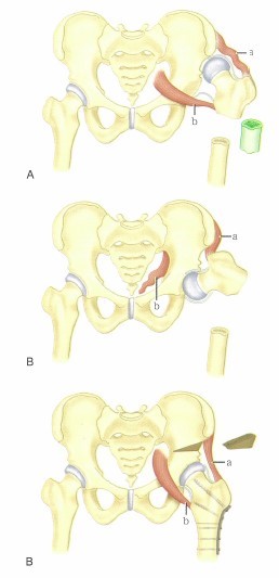 图13 切开复位,一期股骨短缩和salter骨盆截骨.