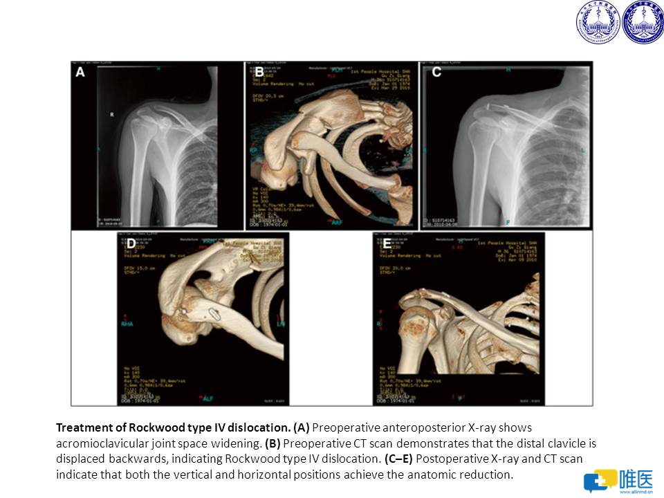 肩鎖關節脫位的診斷與治療,唯醫,allinmd