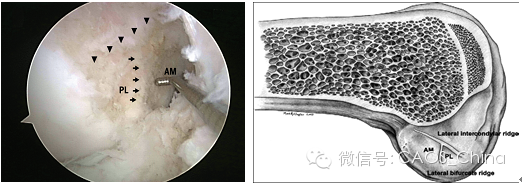 图六 屈膝 90 度,镜下看髁间窝外侧嵴:三角;髁间窝外侧分叉嵴:箭头
