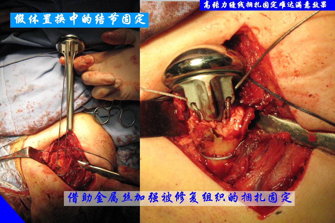 肱骨近端骨折头置换的技术及并发症