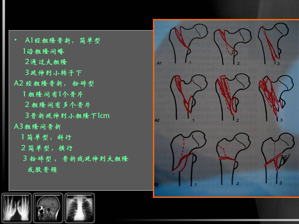 本课程由四川省人民医院骨科王跃教授详细介绍了股骨粗隆间骨折的分型